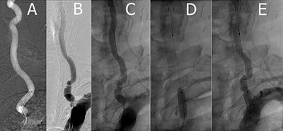 Successful Endovascular Bailout Strategy for Retained Accunet Embolic Protection Device During Vertebral Artery Stenting